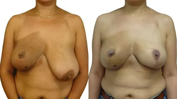 asymetrie mammaire paris symetrisation sein colaterale avant apres resultats docteur alexandre bouhanna chirurgien esthetique paris vincennes 94
