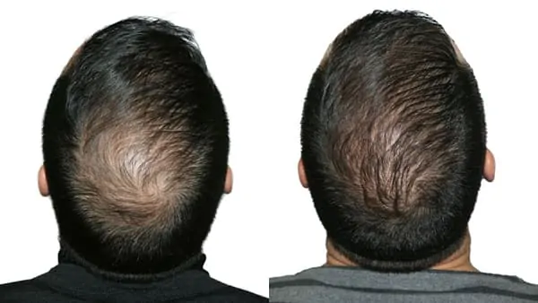 greffe de cheveux paris greffe capillaire avant apres resultats docteur alexandre bouhanna chirurgien esthetique paris vincennes 94