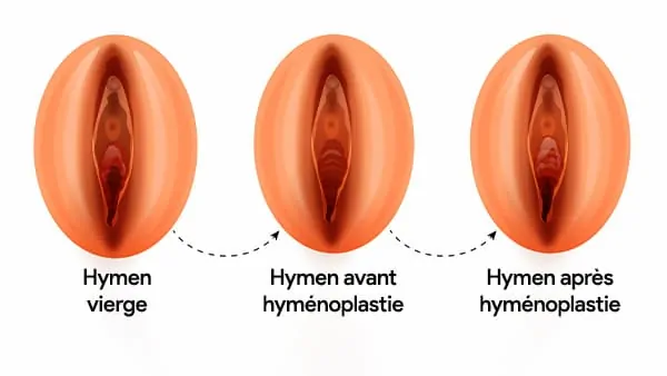 hymenoplastie paris hymenoplastie avant apres reconstruction de l hymen docteur alexandre bouhanna chirurgien esthetique paris vincennes 94