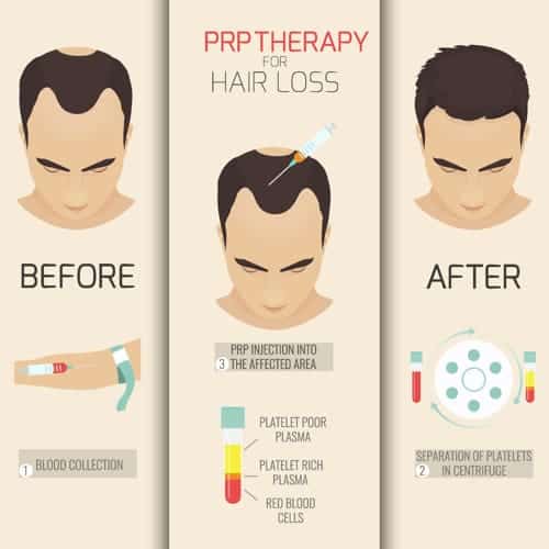 Le traitement par PRP contre la perte de cheveux | Docteur Bouhanna