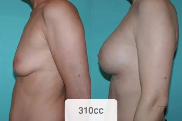 implantation protheses mammaire 310 cc reprise implant mammaire rate chirurgien esthetique paris vincennes docteur alexandre bouhanna avis