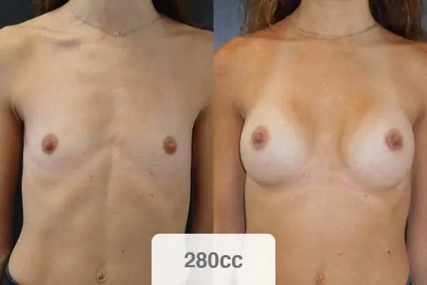 implants mammaire 280cc augmentation mammaire jour apres jour prise en charge chirurgien esthetique paris vincennes docteur alexandre bouhanna avis
