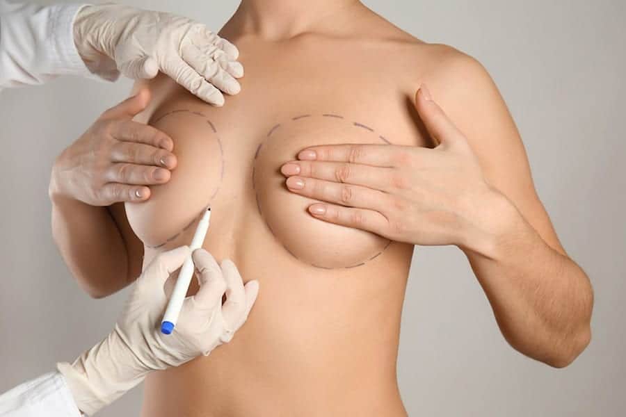 lipofilling mammaire avant apres resultat docteur alexandre bouhanna chirurgien esthetique paris vincennes