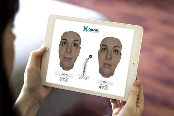 crisalix simulation 3d visage chirurgie esthetique docteur alexandre bouhanna chirurgien esthetique paris