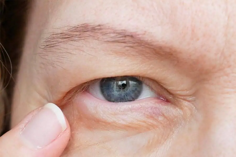 chirurgie paupieres tombantes docteur alexandre bouhanna chirurgien esthetique specialiste chirurgie du visage blepharoplastie paris