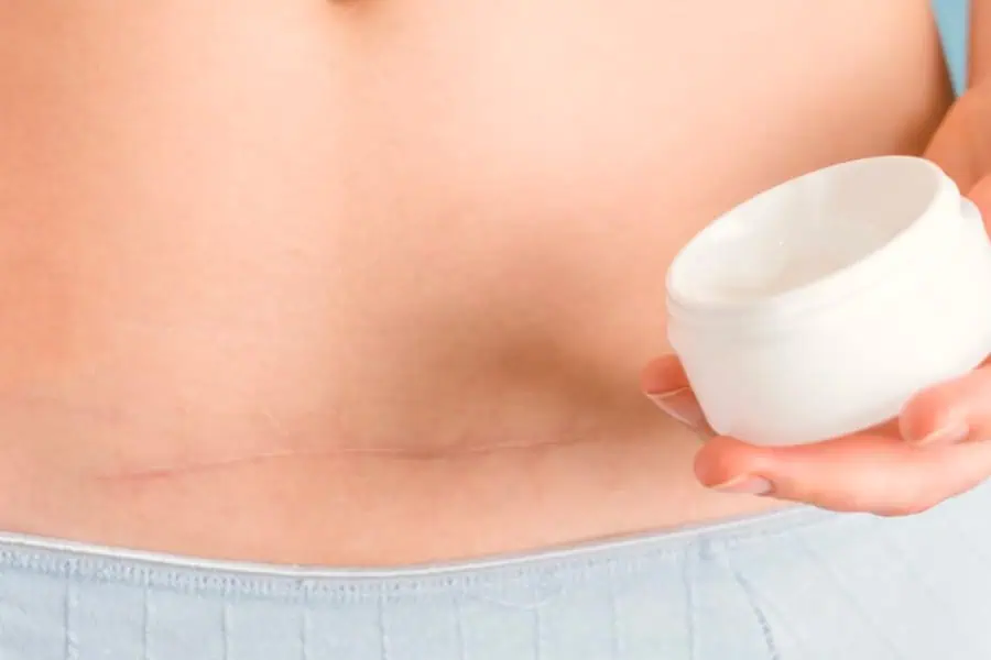 A quoi ressemble une cicatrice d’abdominoplastie 1 an après ?