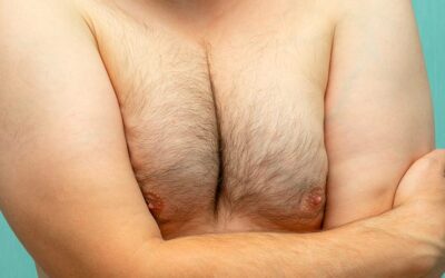 Comment savoir si on a une gynécomastie ?