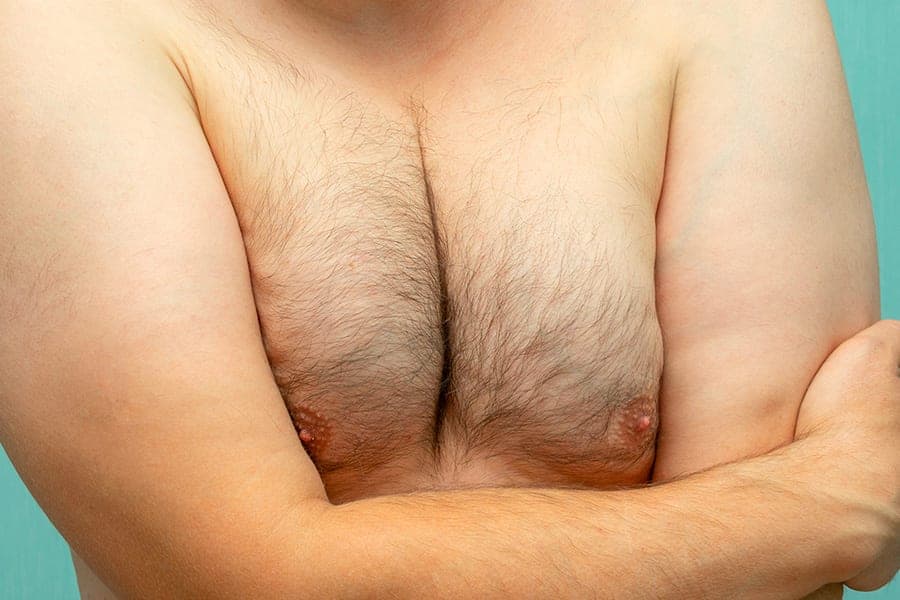 comment savoir si on a une gynecomastie docteur alexandre bouhanna chirurgien esthetique paris