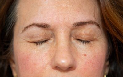 Je regrette ma blépharoplastie : est-il possible de rattraper un résultat décevant ?