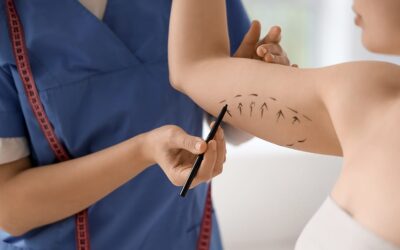 Bras qui pendent : que faire ? La brachioplastie comme solution chirurgicale